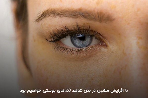 افزایش ملانین از عوامل اصلی ایجاد لکه‌های پوستی