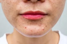بررسی تاثیر کمبود ویتامین‌ها بر ایجاد لک‌های پوستی