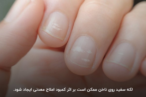 کمبود املاح معدنی؛ یکی از دلایل ایجاد لکه سفید روی ناخن دست و پا