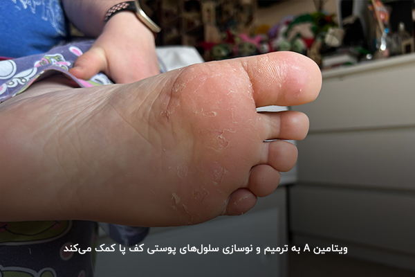 درمان پوسته پوسته شدن کف پا با تامین ویتامین A