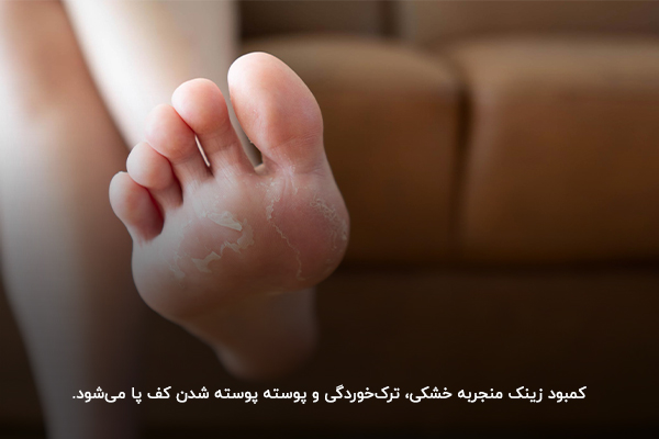 زینک؛ ماده معدنی مفید برای احیای پوست کف پا