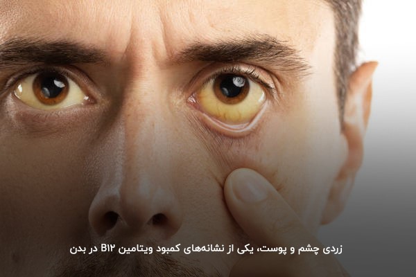 زردی چشم و پوست، یکی از نشانه‌های کمبود ویتامین B12 در بدن