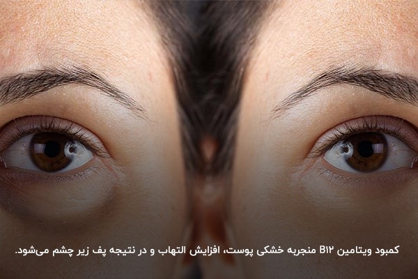 کاهش پف و تورم زیر چشم با تامین ویتامین B12 موردنیاز بدن