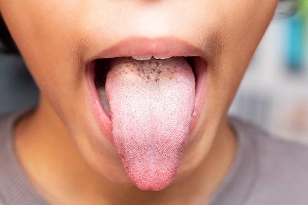 بررسی پاسخ سوال «کمبود کدام ویتامین باعث خشکی دهان میشود» در بلاگ نیچرز